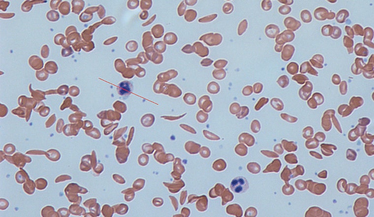 Illinois Advisory Council Tackles Medicaid Reform to Improve Access to Costly Sickle Cell Treatments