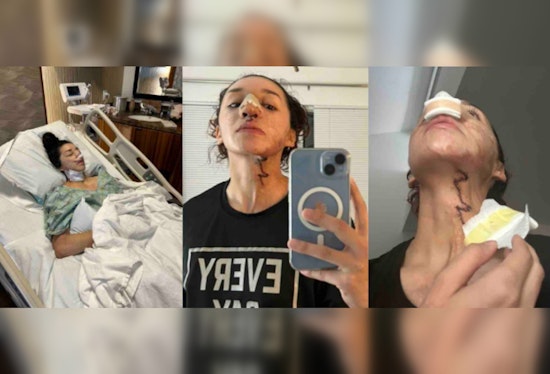 Mililani Acid Attack Survivor Davina Licon Seeks Support Amid Ongoing Recovery and Reconstructive Surgeries