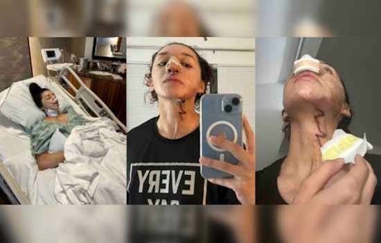 Mililani Acid Attack Survivor Davina Licon Seeks Support Amid Ongoing Recovery and Reconstructive Surgeries