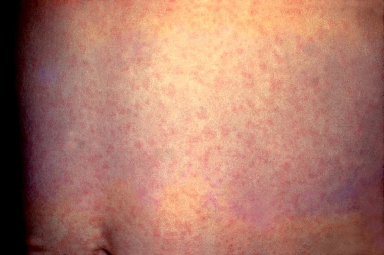 Potential Measles Outbreak in Orange County Linked to Tourist Visits Near Disneyland and LAX