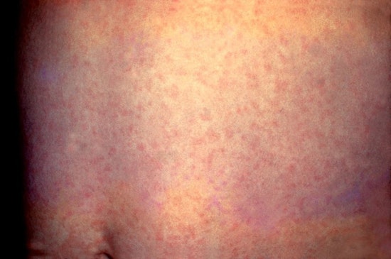 Potential Measles Outbreak in Orange County Linked to Tourist Visits Near Disneyland and LAX