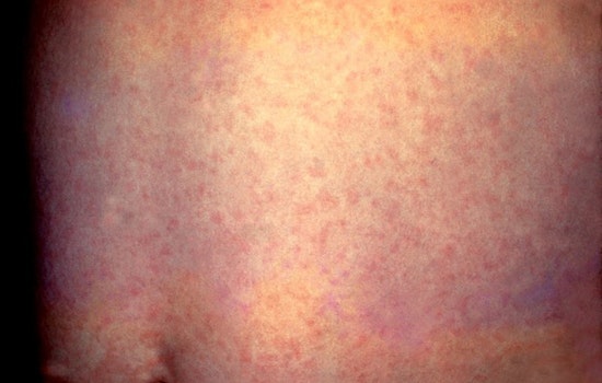 Potential Measles Outbreak in Orange County Linked to Tourist Visits Near Disneyland and LAX