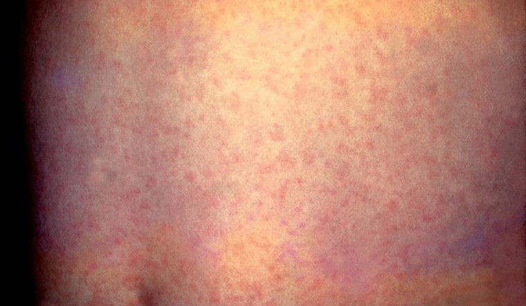 Potential Measles Outbreak in Orange County Linked to Tourist Visits Near Disneyland and LAX
