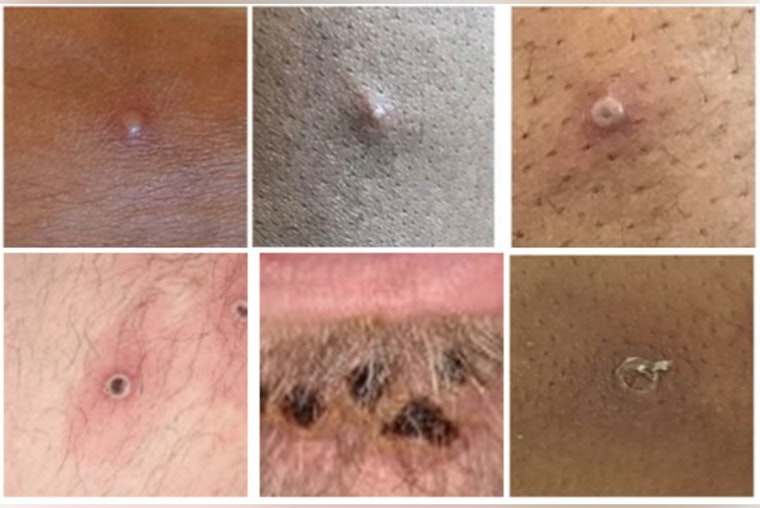 Clark County Reports Seven Mpox Cases as Southern Nevada Health District Urges Public Vigilance and Vaccination