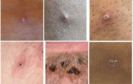 Clark County Reports Seven Mpox Cases as Southern Nevada Health District Urges Public Vigilance and Vaccination