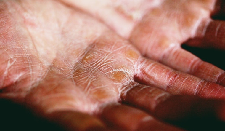 FDA Approves New Eczema Cream Giving Hope to Millions Like Teenager Scott Hedgpeth