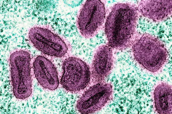 First Mpox Case of the Year Identified in Wayne County Amidst Michigan's Rising Count