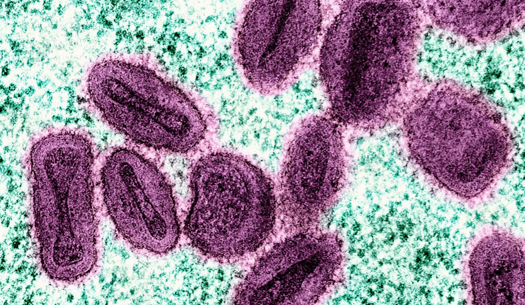 First Mpox Case of the Year Identified in Wayne County Amidst Michigan's Rising Count