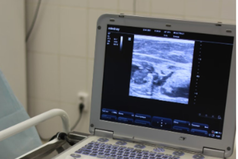 Indiana AG Drops Privacy Suit Against IU Health in Abortion Case Involving Ohio Girl