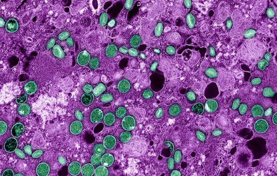San Francisco Public Health Confirms No New Mpox Cases, Urges Vaccination Amid Wastewater Detection