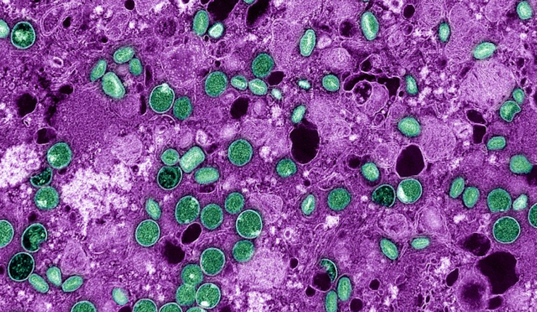 San Francisco Public Health Confirms No New Mpox Cases, Urges Vaccination Amid Wastewater Detection