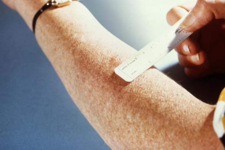 Tuberculosis Exposure at Mount Miguel High School in Spring Valley Prompts Public Health Response
