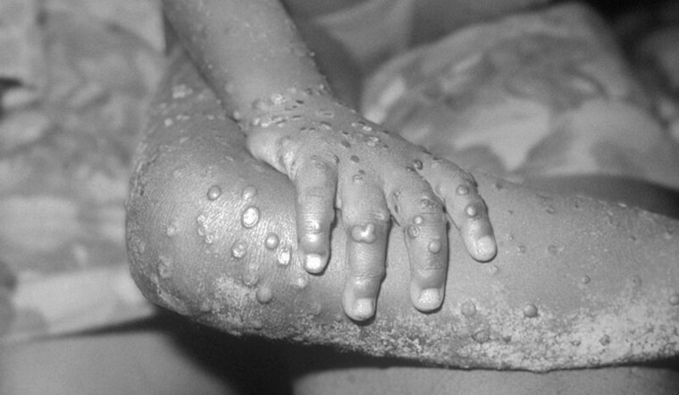 Los Angeles County Faces Surge in Mpox Cases as Public Health Urges Vaccinations