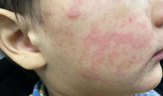 Measles Exposure Alert Issued at Seattle-Tacoma International Airport, Snohomish County Health Dept. Monitors Two Individuals