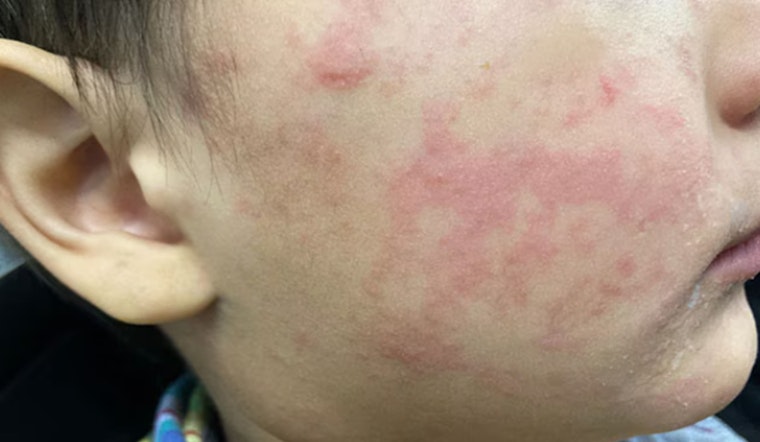 Measles Exposure Alert Issued at Seattle-Tacoma International Airport, Snohomish County Health Dept. Monitors Two Individuals