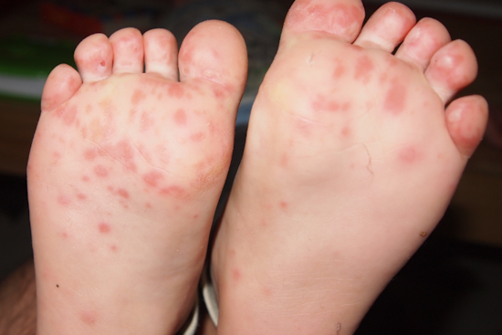 Anne Arundel County Battles Surge in Hand, Foot and Mouth Disease Outbreaks in Schools