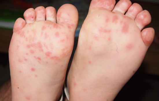 Anne Arundel County Battles Surge in Hand, Foot and Mouth Disease Outbreaks in Schools