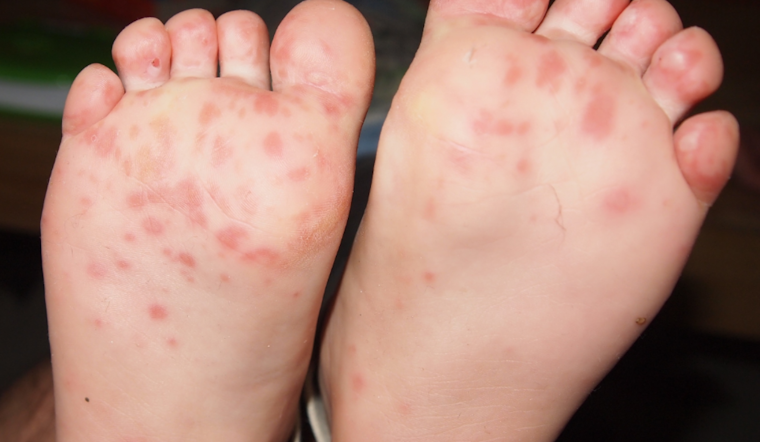 Anne Arundel County Battles Surge in Hand, Foot and Mouth Disease Outbreaks in Schools