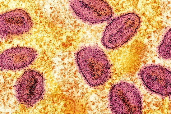 First Clade I Mpox Case Without Travel History Confirmed in Long Beach; Health Officials Urge Vigilance and Vaccination