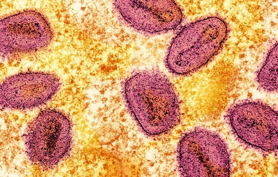 First Clade I Mpox Case Without Travel History Confirmed in Long Beach; Health Officials Urge Vigilance and Vaccination