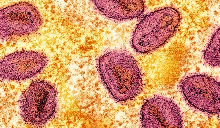 First Clade I Mpox Case Without Travel History Confirmed in Long Beach; Health Officials Urge Vigilance and Vaccination
