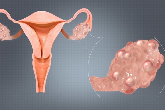 University of Minnesota Spotlights Need for Enhanced PCOS Awareness and Education