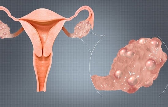 University of Minnesota Spotlights Need for Enhanced PCOS Awareness and Education