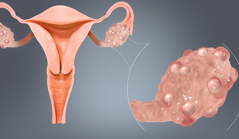 University of Minnesota Spotlights Need for Enhanced PCOS Awareness and Education