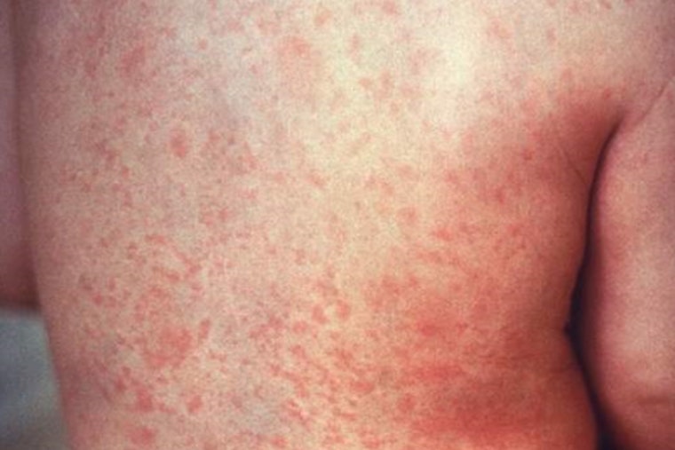 Clark County Confronts First Infant Measles Case Since 2018, Health Officials Urge Public Vigilance