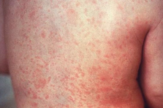 Clark County Confronts First Infant Measles Case Since 2018, Health Officials Urge Public Vigilance