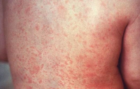 Clark County Confronts First Infant Measles Case Since 2018, Health Officials Urge Public Vigilance