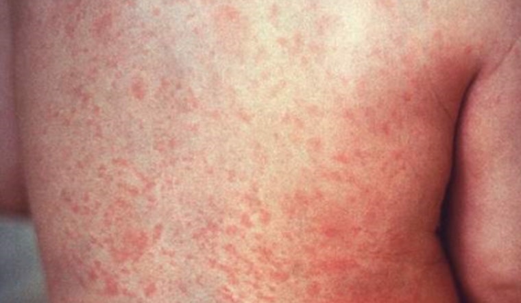 Clark County Confronts First Infant Measles Case Since 2018, Health Officials Urge Public Vigilance