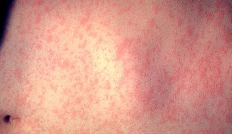 Health Officials Issue Alert After Possible Measles Exposure at Philadelphia Airport