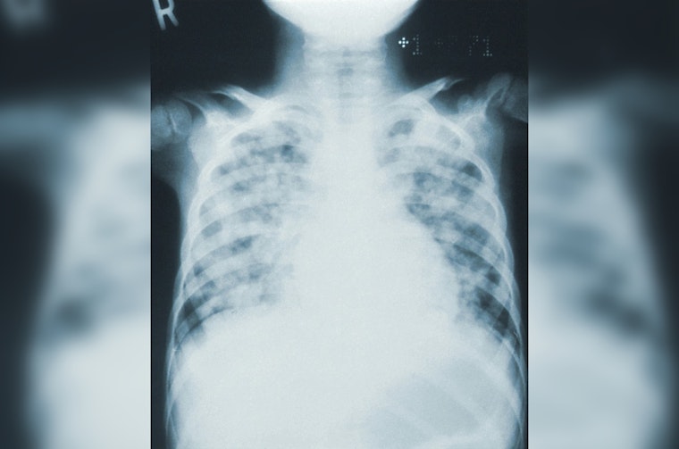 Mayor Bowser and DC Health Amplify Efforts for Early Lung Cancer Detection and Prevention in Washington, DC