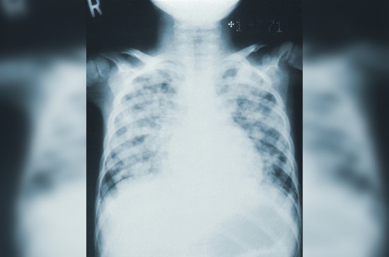 Mayor Bowser and DC Health Amplify Efforts for Early Lung Cancer Detection and Prevention in Washington, DC