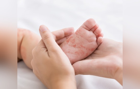 Measles Exposure Alert for Flagstaff Mall Visitors on November 6th, Health Officials Advise Vigilance