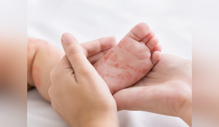 Measles Exposure Alert for Flagstaff Mall Visitors on November 6th, Health Officials Advise Vigilance
