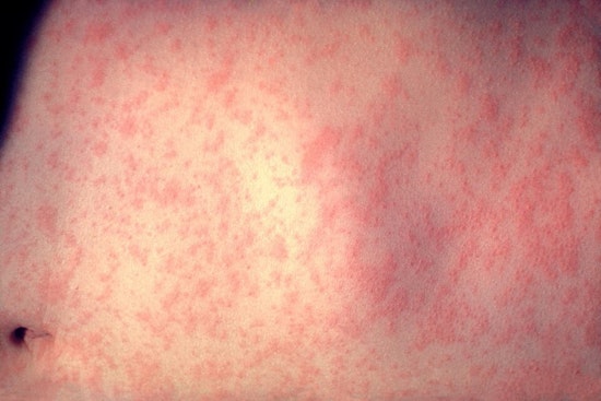 Salt Lake County Reports First Measles Case Amid National Outbreak, Unknown Source Concerns Health Officials