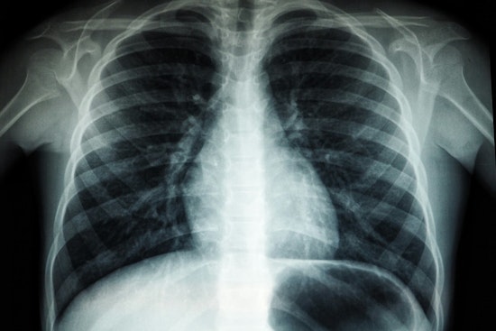 Young Women’s Lung Cancer Surge Has Chicago Docs On High Alert