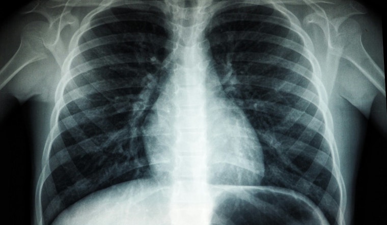Young Women’s Lung Cancer Surge Has Chicago Docs On High Alert