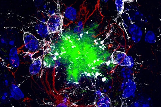 Dallas Brain Lab Rebuilds Tau Protein To Thwart Alzheimer’s Clumps