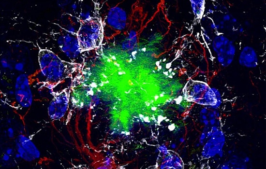 Dallas Brain Lab Rebuilds Tau Protein To Thwart Alzheimer’s Clumps