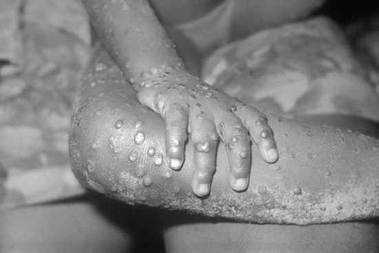 El Paso On Alert As First Mpox Case Of 2025 Triggers Contact Tracing Push