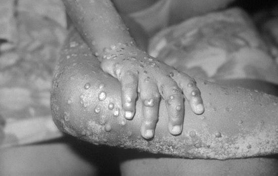 El Paso On Alert As First Mpox Case Of 2025 Triggers Contact Tracing Push