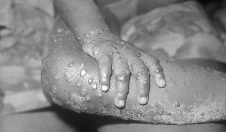 El Paso On Alert As First Mpox Case Of 2025 Triggers Contact Tracing Push