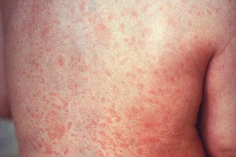 Hawaii DOH Detects Second Instance of Measles Virus in Maui Wastewater, No Confirmed Cases Reported