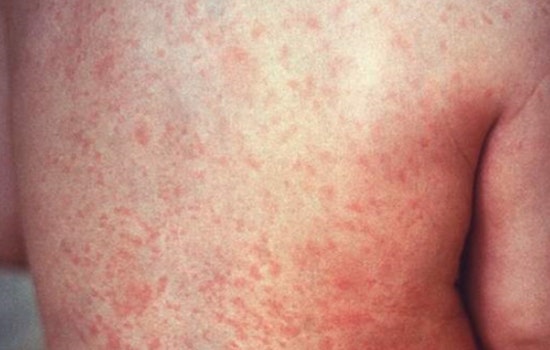 Hawaii DOH Detects Second Instance of Measles Virus in Maui Wastewater, No Confirmed Cases Reported