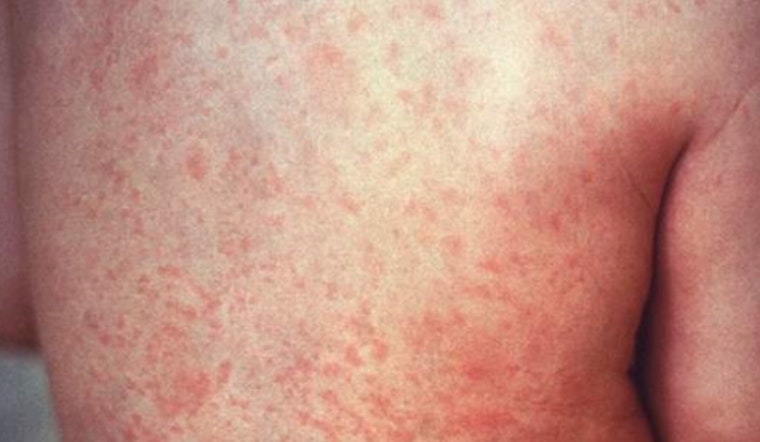 Hawaii DOH Detects Second Instance of Measles Virus in Maui Wastewater, No Confirmed Cases Reported
