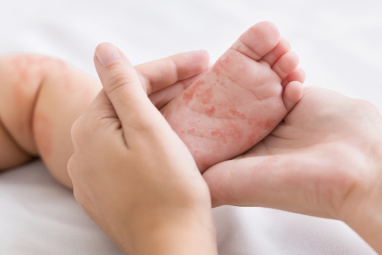 Health Alert Issued in Coconino County After Resident Diagnosed with Measles, Public Urged to Monitor Symptoms