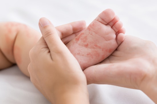 Health Alert Issued in Coconino County After Resident Diagnosed with Measles, Public Urged to Monitor Symptoms